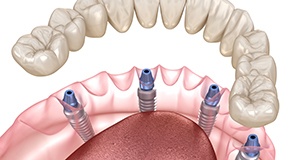 Digital illustration of all-on-4 dental implants