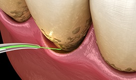 Illustration of laser periodontal treatment